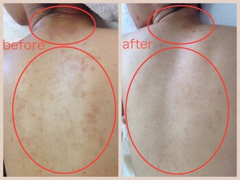 サロン ド ラポール/背面の肌トラブルも改善