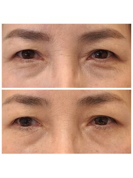 ビハダ(BeHADA)/#目の脂肪再配置