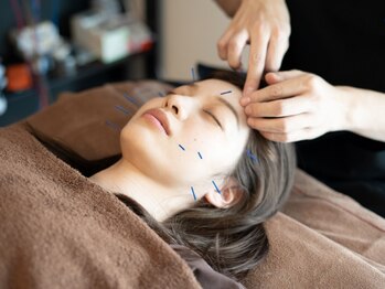 カガヤキ 博多竹下(Kagayaki)の写真/美容鍼で短期間で驚きの結果!!今なら初回美容鍼￥3500！【圧倒的な知識量×技術で違いを実感】