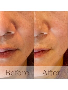 凪眠/小顔リンパフェイシャルの効果12