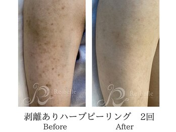 ミーシェ(Meshie)/リベルハーブピーリング施術前後