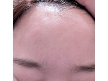 ブリリアンス(BRILLIANCE)/グリーンピールで肌質改善！