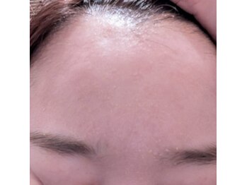 ブリリアンス(BRILLIANCE)/グリーンピールで肌質改善！