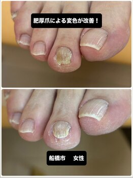 巻き爪じゅん 船橋店/肥厚爪変色に専門施術で根本改善