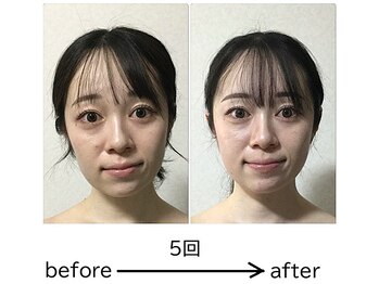 チコ(chiko)/5回ビフォーアフター写真