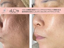 スローティ ラテ 旭川店/やって良かったピーリング♪