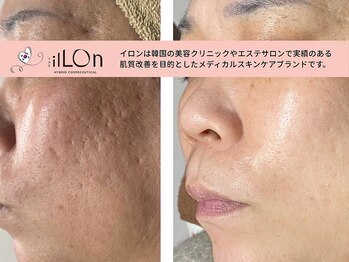 スローティ ラテ 旭川店/やって良かったピーリング♪