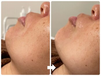 サロン ド ジョワ(salon de joie)/高保湿でほうれい線改善