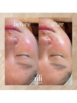 ウリ(uli beauty)/比較写真