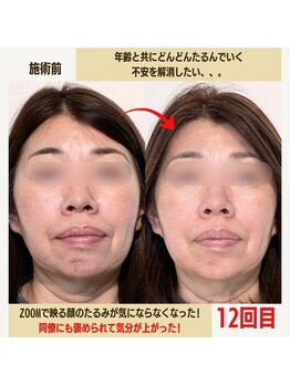 経堂鍼灸整体院/幹細胞美容鍼+小顔矯正