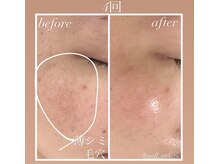 ノフ 恵比寿(noff)の雰囲気（最新!!第五世代!!【ララピール進化版】ダクトピール×美容鍼★）
