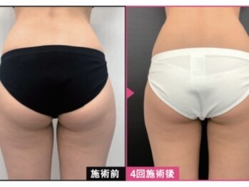 ホアロハ(Hoaloha)/ビーストロング～ビフォアフ～