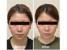 小顔22 ボルティ 赤坂支店(Bolty)/20代：施術1回