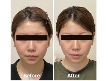 小顔22 ボルティ 赤坂支店(Bolty)/20代：施術1回