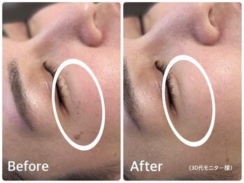 ラウレア(LAULEA)/シミ改善Before/After(1ヶ月)