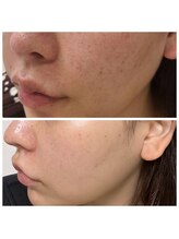 ビハダ(BeHADA)/毛穴/ニキビケア