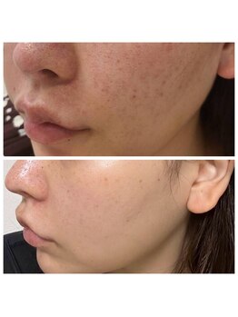 ビハダ(BeHADA)/毛穴/ニキビケア