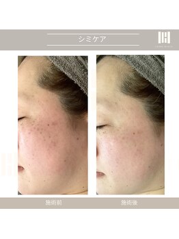 カリスボーテ 関本店/シミケア