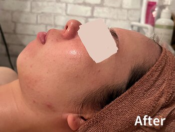 ダイヤモンド リーエンダ(Diamond leende)/クレイハーブピーリング