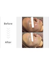 ラヴィオス 渋谷表参道店(RAVIOS)/肌質改善/ハーブピーリング