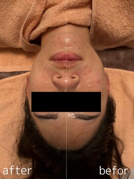 にっこりビューティー/★EMSマッサージ+エアバリ