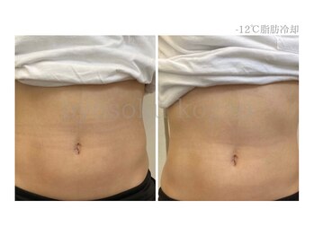 メディカルエステ 新宿店/＊日本初-12℃脂肪冷却症例＊