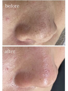 ネイルサロン きらら 平塚店/before／after　毛穴洗浄