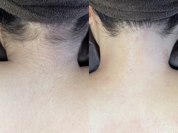 モルフォム(Morphome)/うなじ・背中脱毛