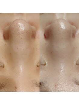 マイフェアレディ 今池(MyFairLady)/韓国肌管理メで透明感のある美肌