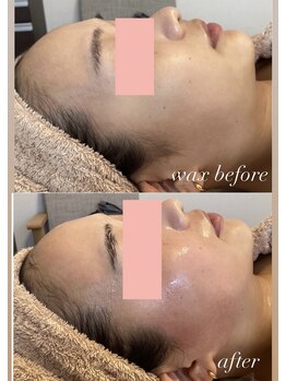 ソラ 六本松店(SORA)/お顔のWax脱毛