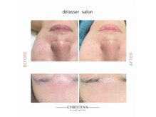 デラッセ サロン ギンザ 藤枝店(Delasser salon GINZA)の雰囲気（クリスティーナ×韓国iLLONで本気の肌質改善！毛穴ニキビケア）