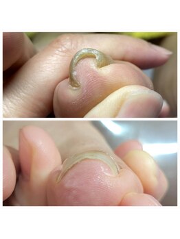nail salon Cyan & Dr.ネイル【11/1 NEW OPEN(予定)】の写真/【足元のお悩み解消】巻き爪・角質・魚の目も徹底ケア★歴8年の専門知識で老若男女問わず健康的な素足へ♪