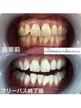 ホワイトニングサロン 京都烏丸店/ホワイトニング施術例