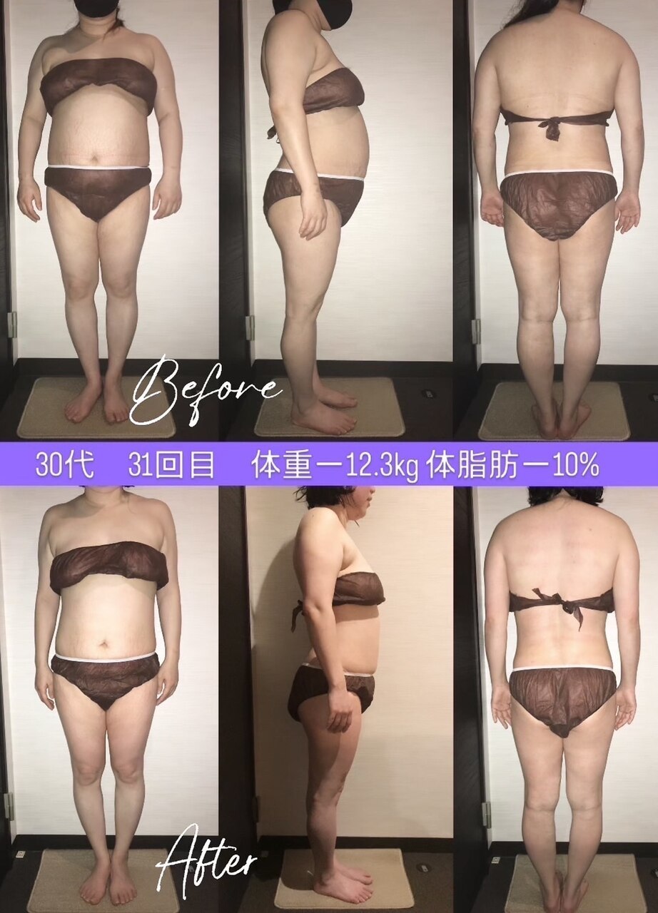 シェイプリフト　定価約30万　美容　痩身　ダイエット 千葉市若葉区の痩身、脂肪を減らし体を細くしたいなら希楽鍼灸