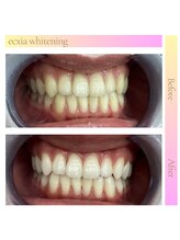 エクシアホワイト 広島袋町店/ホワイトニングビフォーアフター