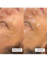 ミーティス/Gloss肌ピーリングでシワケア♪