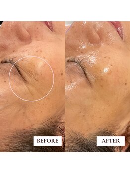 ミーティス/Gloss肌ピーリングでシワケア♪