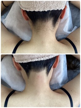 ルルトウキョウ 池袋店(LULU.tokyo)/うなじ脱毛