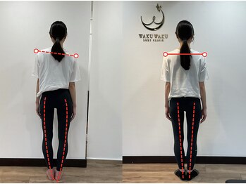 ワクワクボディ 横浜店(WAKUWAKU BODY)/30代|6か月|体の傾き・O脚改善