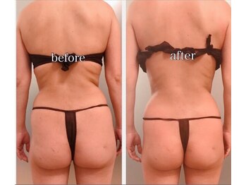 レボン(Rebon)/★スリムムーブ★Before→After