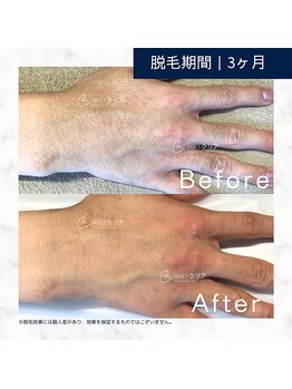 メンズクリア 高知帯屋町店/【メンズクリア】お客様の施術例