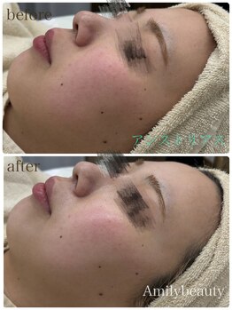 アミリービューティー ひたち野うしく店(Amily beauty)/【アンストレス】