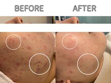 ライム 立川(LIME)/ハーブピーリング｜ニキビケア