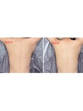 ラヴィオス 渋谷表参道店(RAVIOS)/肌質改善/ハーブピーリング