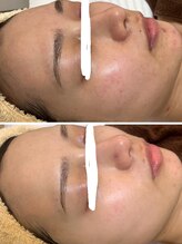 ジェニー(JENNI)/LDMコース　施術４回