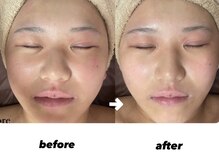 アース 津田沼店(EARTH Eye & Aesthetic)/【美白・美肌コース】1回