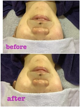 エステティックジュビラン アメジスト/一度の施術でも変わります!