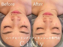 シエリー 原宿本店(Ciely)/シミもハーブピーリングで退治♪