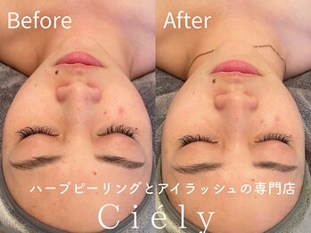 シエリー 原宿本店(Ciely)/シミもハーブピーリングで退治♪