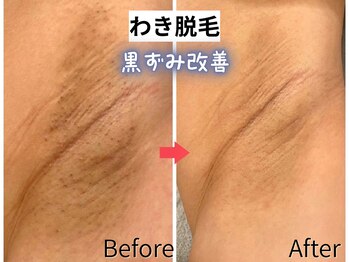 エトワール(etoile)/美肌脱毛！わきの黒ずみ改善！